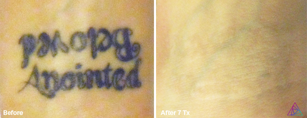 Before and after tattoo removal